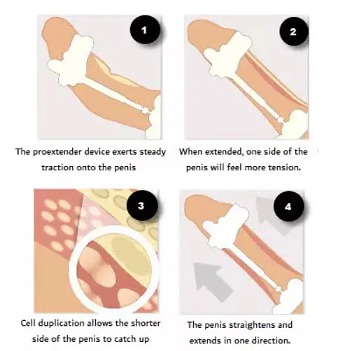 Pro Extender Penis Enlargement System - Master